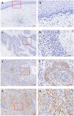 The complement regulatory protein CD46 serves as a novel biomarker for cervical cancer diagnosis and prognosis evaluation